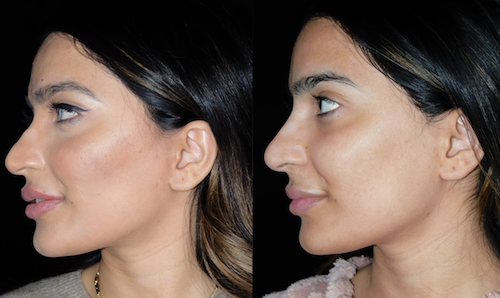 Nose Filler Reshaping Before After Mississauga Oakville